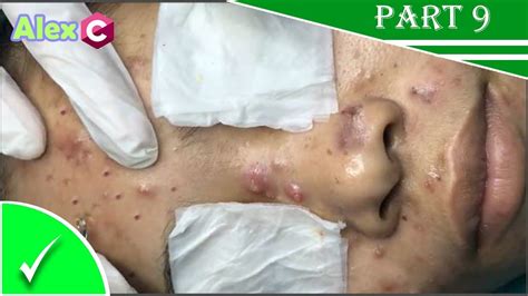 The cyst may become <b>large</b> enough to drain the rotten skin cells, these cells cause the putrid smell. . Large cystic acne removal